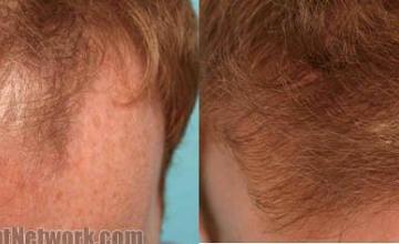 Hair restoration procedure before and after results