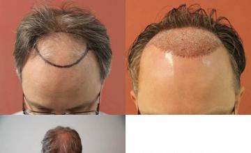 Hair restoration procedure before and after results