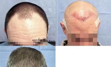 Hair transplantation surgery before and after photos