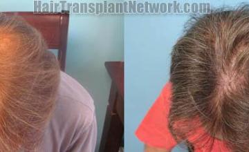 Surgical hair transplantation result photographs