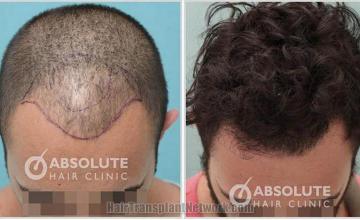 Hair restoration procedure before and after result photos