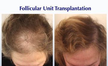 Female before and after hair transplant procedure images