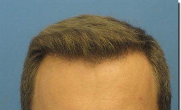 Hair restoration procedure results