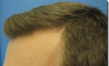 Hair restoration procedure results