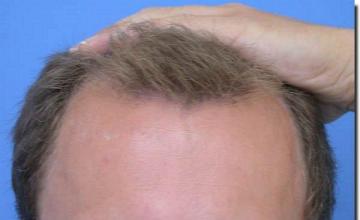 Hair restoration procedure results