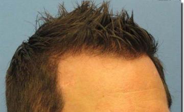 Hair restoration procedure results