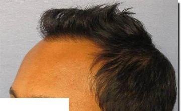 Hair restoration procedure results