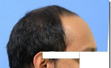 Hair restoration procedure results