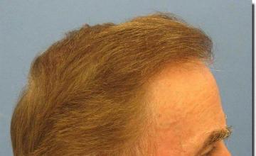 Hair restoration procedure results