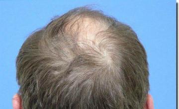 Hair restoration procedure results