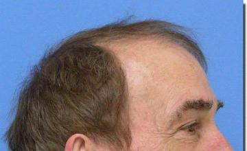 Hair restoration procedure results