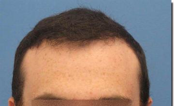 Hair restoration procedure results