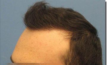 Hair restoration procedure results