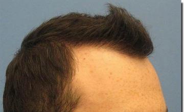 Hair restoration procedure results