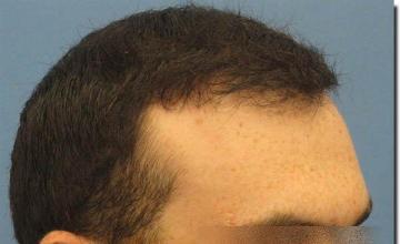 Hair restoration procedure results