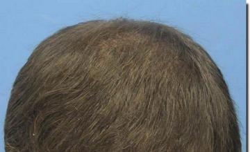 Hair restoration procedure results