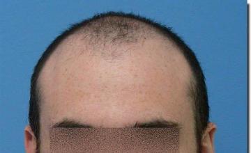 Hair restoration procedure results