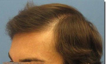 Hair restoration procedure results