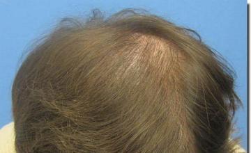 Hair restoration procedure results