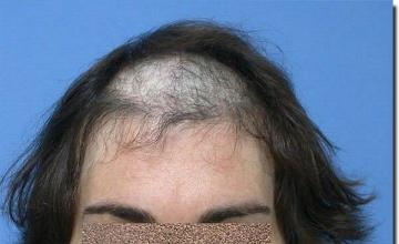 Hair restoration procedure results