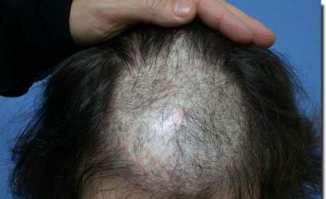 Hair restoration procedure results