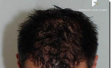 Hair restoration procedure results