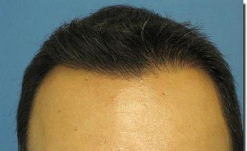 Hair restoration procedure results