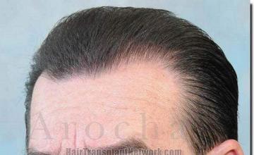 Hair restoration procedure results