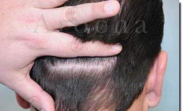 Hair restoration procedure results