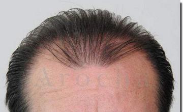 Hair restoration procedure results