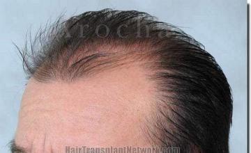 Hair restoration procedure results