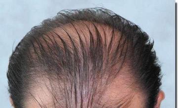 Hair restoration procedure results