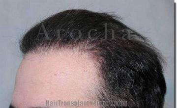 Hair restoration procedure results