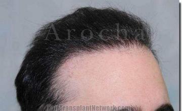 Hair restoration procedure results