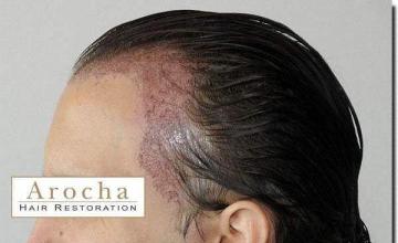 Hair restoration procedure results