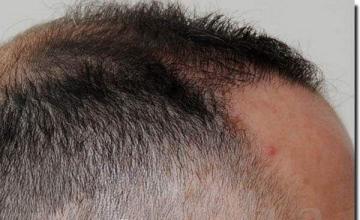 Hair restoration procedure results