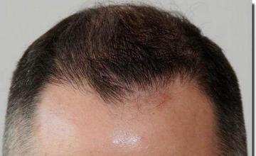 Hair restoration procedure results