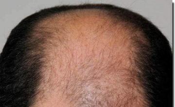 Hair restoration procedure results