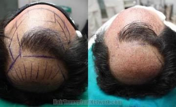 Hair transplantation surgery before and after pictures