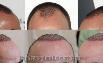 Hair restoration procedure before and after results