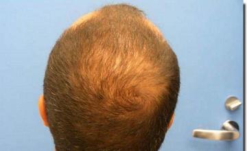 Hair restoration procedure results