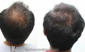 Hair restoration procedure before and after pictures