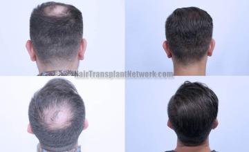 Surgical hair transplantation result photographs