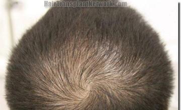 Hair restoration procedure results