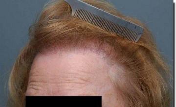 Hair restoration procedure results