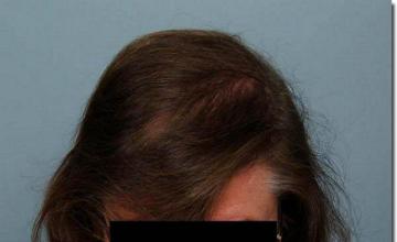 Hair restoration procedure results