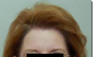 Hair restoration procedure results