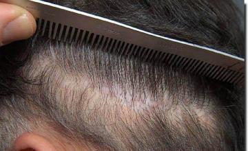 Hair restoration procedure results