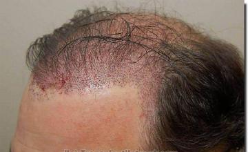 Hair restoration procedure results