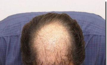 Hair restoration procedure results